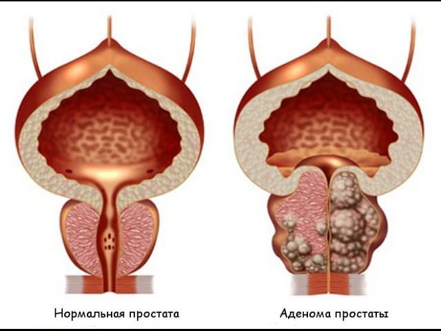 Аденома простаты