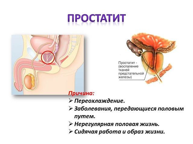 Простатит