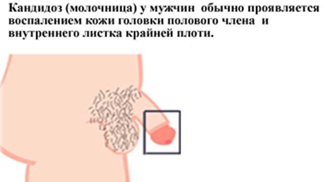 молочница у мужчин