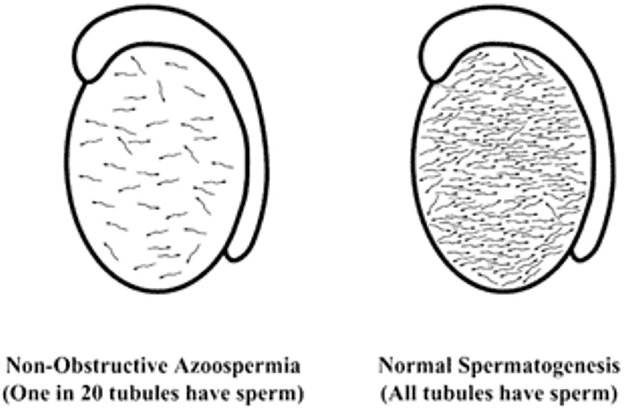 Азооспермия 