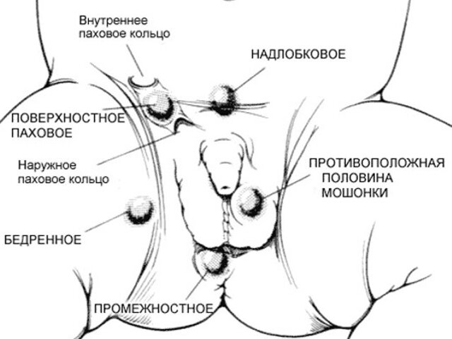 Расположение яичек при крипторхизме