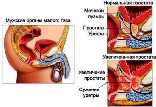 Рак простаты