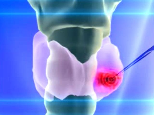 Биопсия взятие