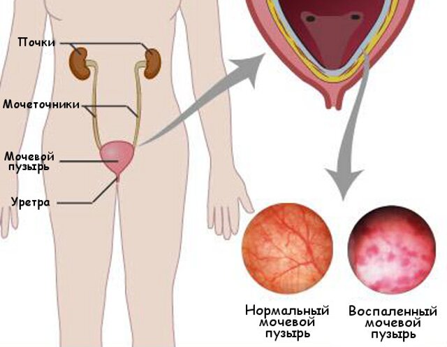 цистита 