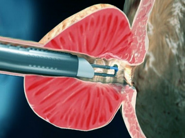 удаления лазером простатита