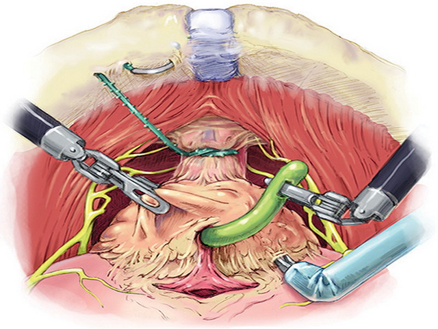 хирургическая операция удаления предстательной железы операция Аденомэктомия