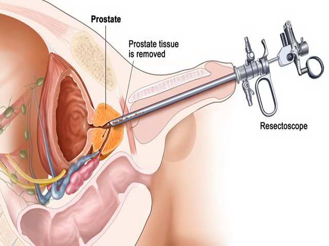 Трансуретральная резекция мочевого пузыря Трансуретральная резекция