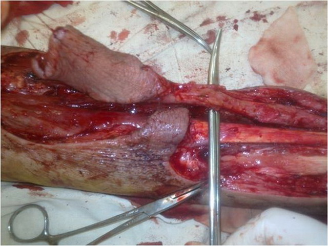 удаления путем Аденомэктомия Аденомэктомия