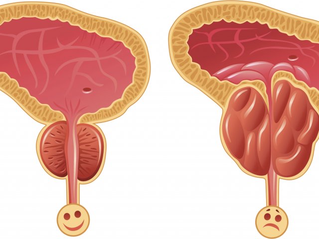 Простатит у мужчин Воспаление простаты