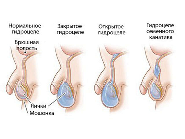 Водянка яичек