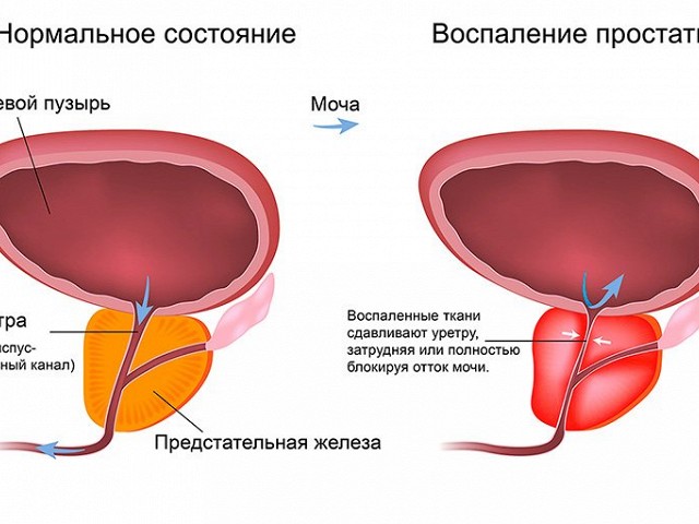 Воспаление