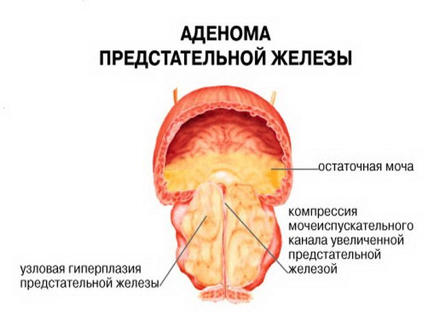 Аденома