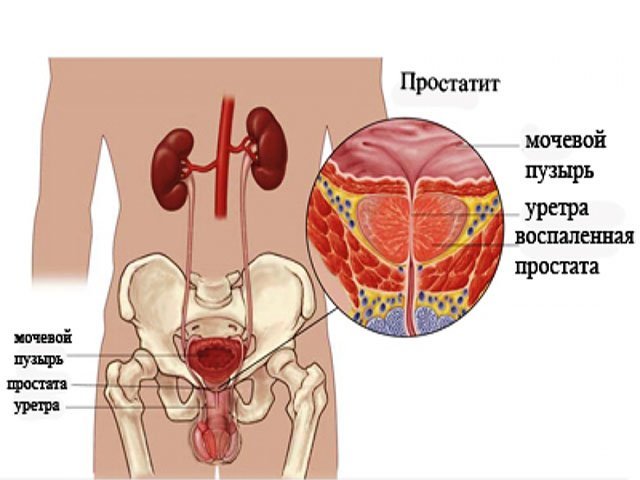 Простатит