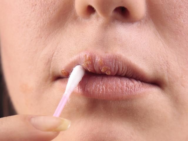 Прижигание воспаления 