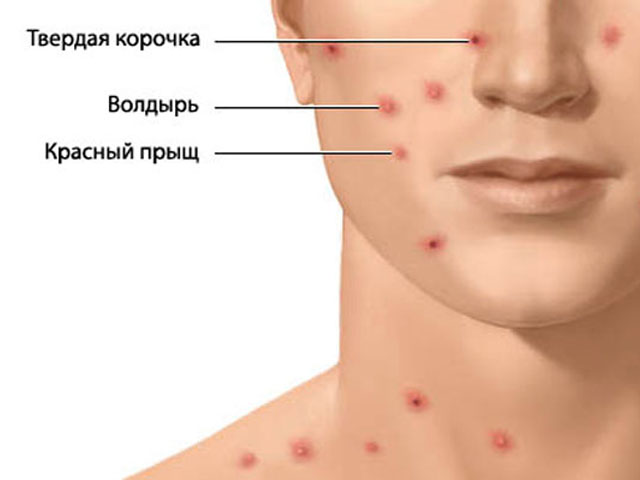 Симптомы заболевания 