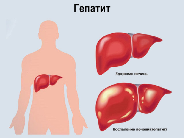 Схема заболевания