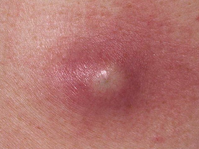 Образование на коже 