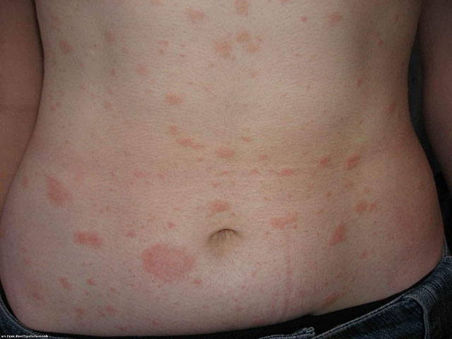 Поражение кожи 