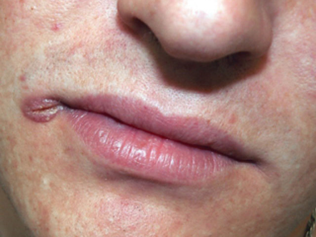 Разорвавшееся образование 