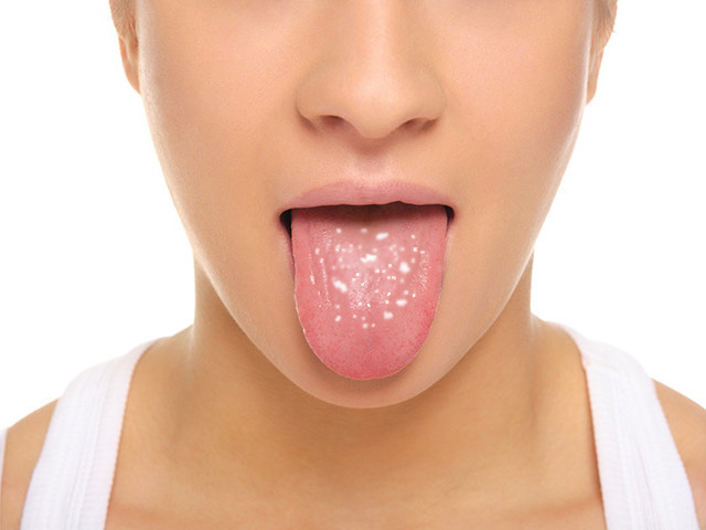 Грибок на языке 