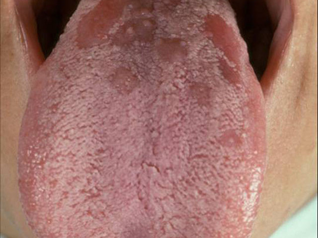 Поражение слизистой оболочки 