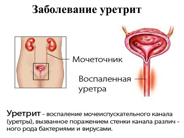 Заболевание уретрит Схематический рисунок