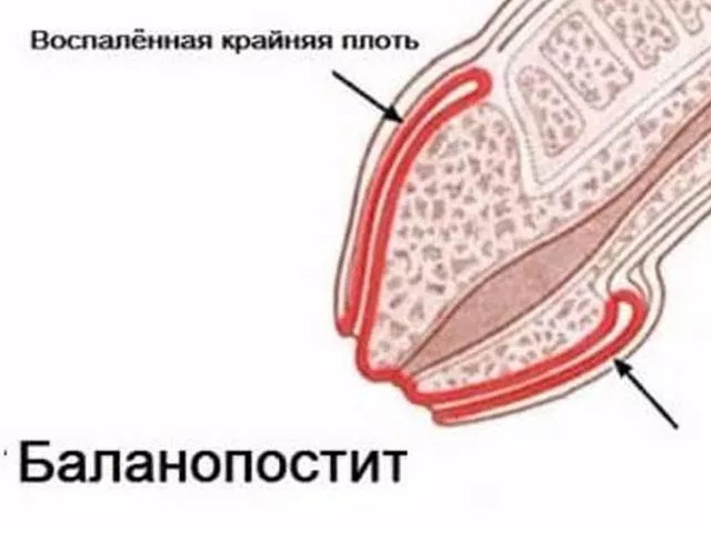 Заболевание баланопостит Схематический рисунок