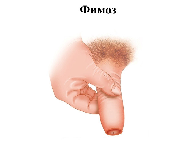 Детская патология Схематический рисунок