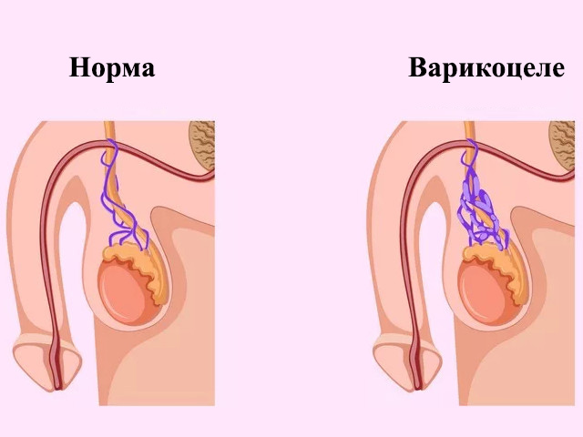 Схема заболевания 