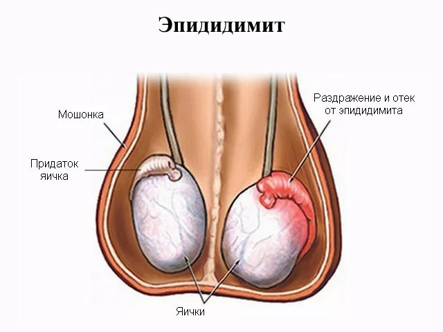 Схема заболевания 