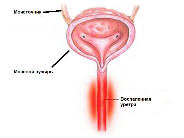 Заболевание уретрит Схематический рисунок