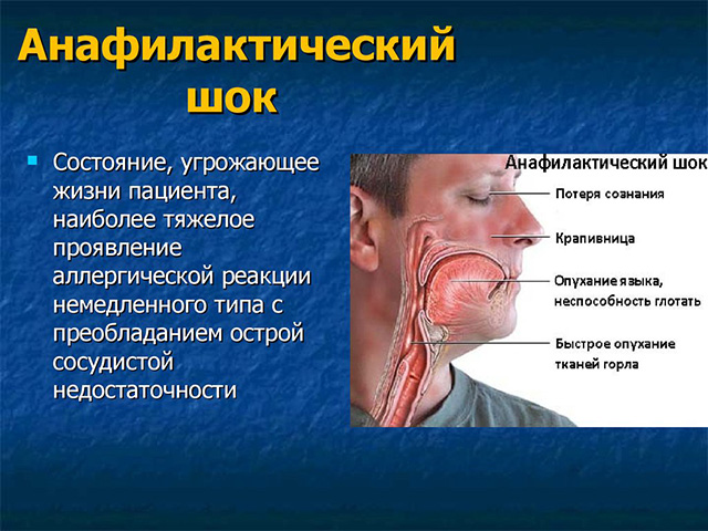 Схема заболевания 