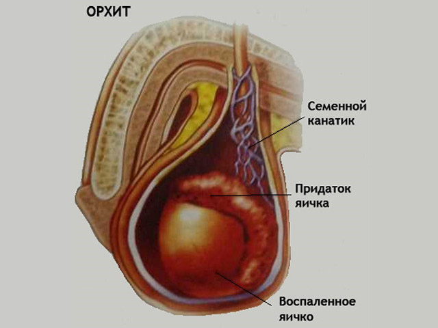 Схема заболевания 