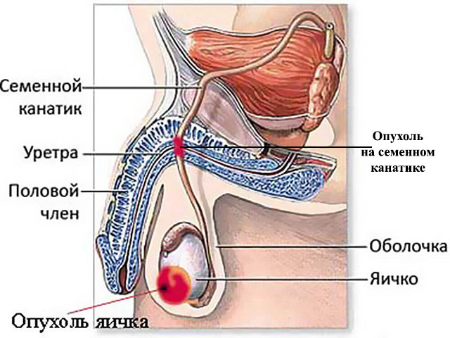 Злокачественная опухоль Схематический рисунок