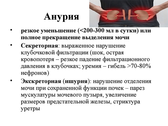 Анурия