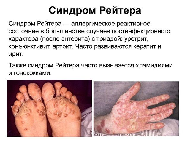 Болезнь Рейтера Аллергические высыпания