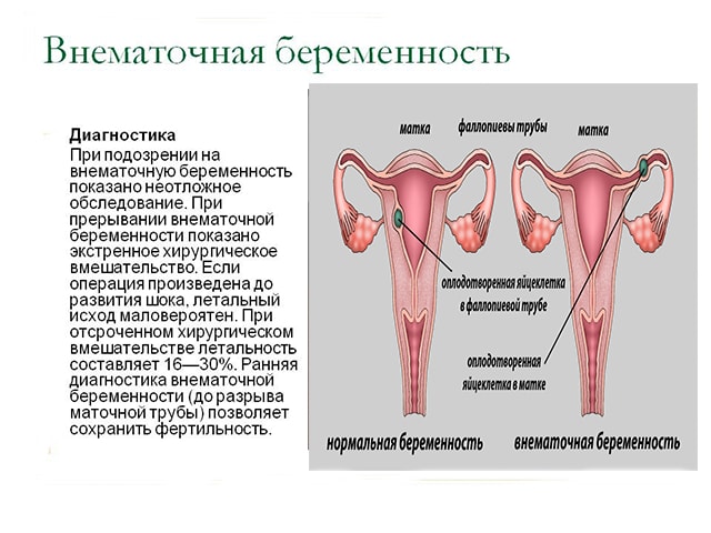 Осложнения: внематочная беременность