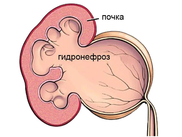 Осложнения 