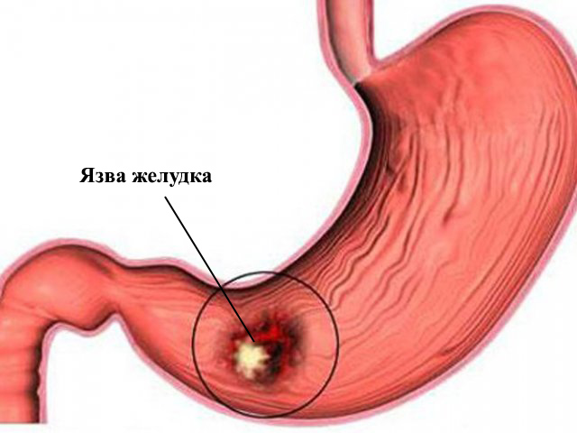 При язве желудка принимать препарат не рекомендуется Схематический рисунок