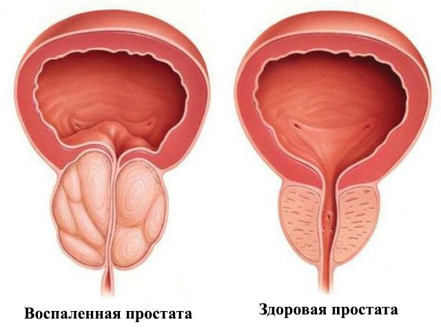 Препарат можно принимать в качестве профилактики простатита Схематический рисунок