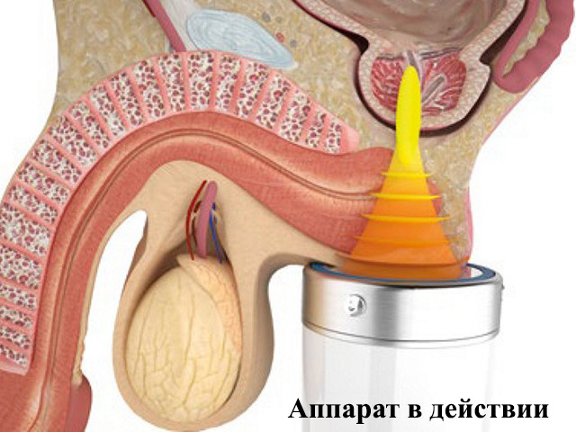 Аппарат в действии  Схематический рисунок