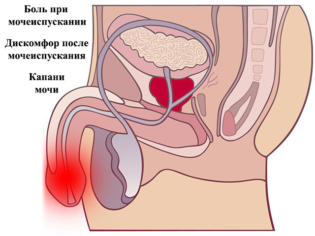 Симптомы заболевания Схематический рисунок
