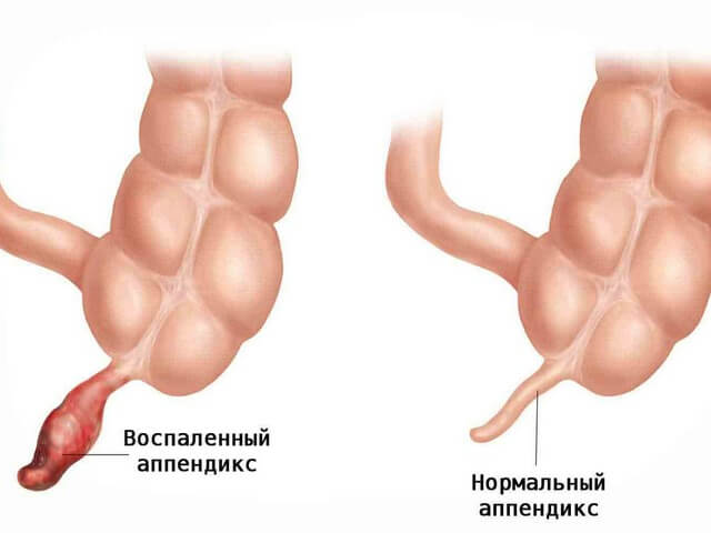 Аппендицит