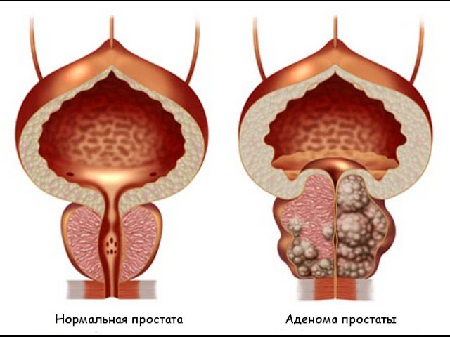 Заболевание простаты