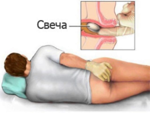 Как применять свечи Витапрост