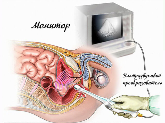 Исследование через прямую кишку