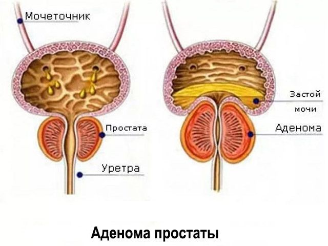 Увеличение простаты