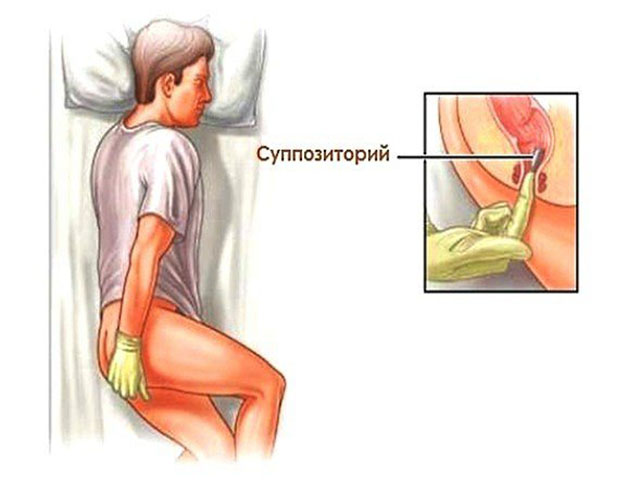 Свечи от простатита