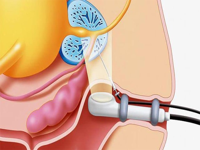 Узи простаты