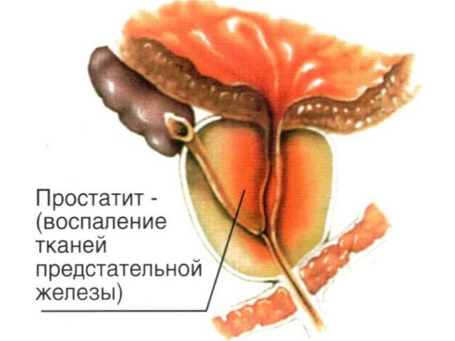 Лечение антибиотиком